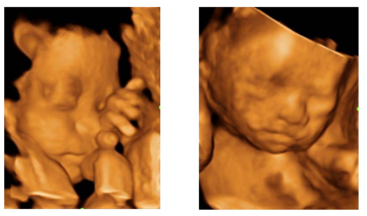 3D/4D Imaging