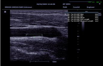 IMT (Intima-Media Thickness)