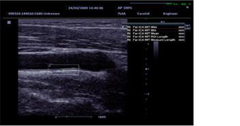 Intima-Media Thickness