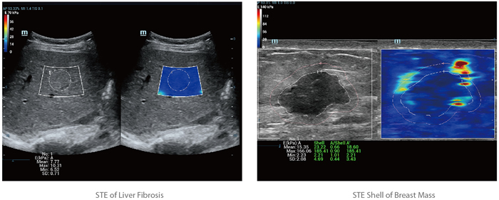 Sound Touch Elastography (STE)