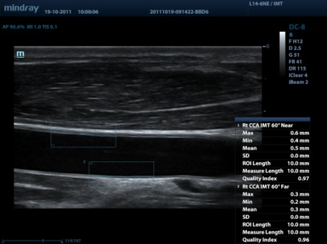 Auto IMT (Intima-Media Thickness)
